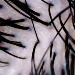 頭皮が赤いのは薄毛の危険がある!?色の変化は頭皮トラブルのサイン
