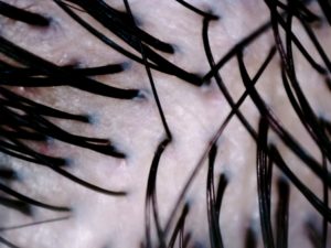 頭皮が赤いのは薄毛の危険がある！?色の変化は頭皮トラブルのサイン