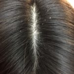 頭皮から出るフケの種類で薄毛を判断できることをご存知ですか?