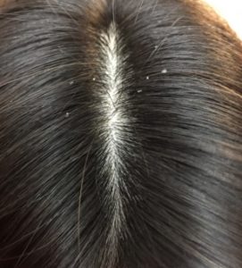 頭皮から出るフケの種類で薄毛を判断できることをご存知ですか?