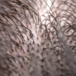 薄毛チェックをして早期に対策を行えば改善率が上がる