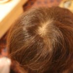 つむじが広いのは薄毛(AGA)の危険!?広いときの対処法5選