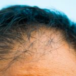 ハゲと薄毛の違いとは?薄毛対策はお早めに！