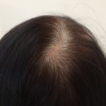 若ハゲになる20代や30代の女性が急増!原因と対策を徹底解明!